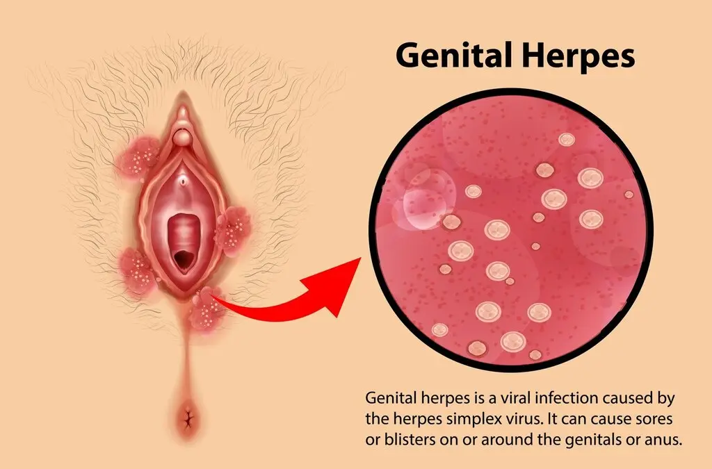 Ufahamu Ugonjwa Wa Genital Warts (Kuota Vinyama Sehemu Za Siri) Na Tiba Yake.