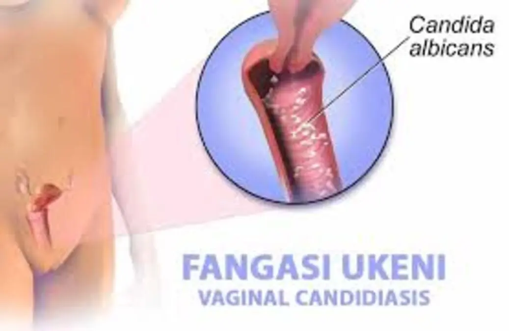 Zijue Dawa Za Asili Za Fangasi Ukeni Zijue Dawa Za Asili Za Fangasi Ukeni