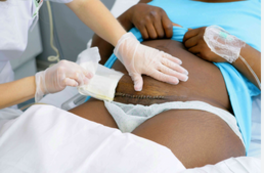 Jinsi ya kulala kwa mama aliyejifungua kwa operation