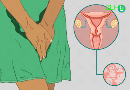 Sababu ya kutoka uchafu mweupe ukeni