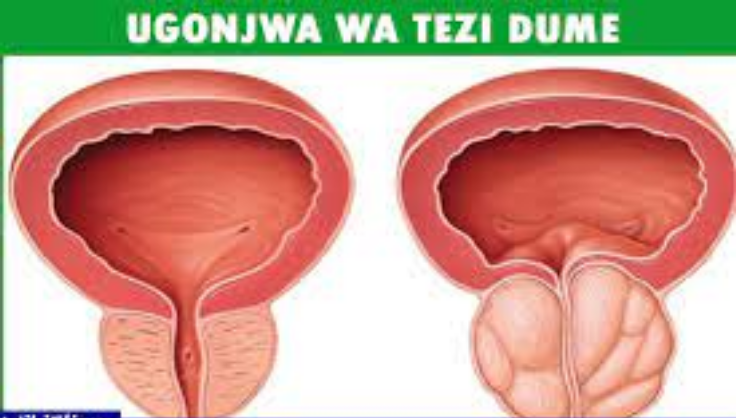 Ugonjwa wa tezi dume husababishwa na nini
