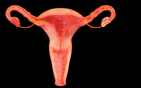 Dalili na Tiba za Ugonjwa wa fibroids