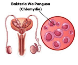 Dalili za Ugonjwa wa Pangusa, Sababu na Dawa za kutibu