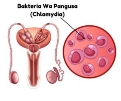 Dalili za Ugonjwa wa Pangusa, Sababu na Dawa za kutibu