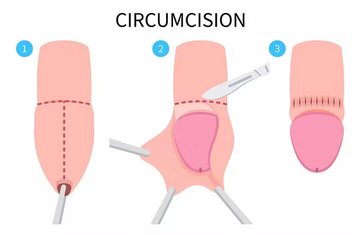 Dawa ya kupaka ya kukausha kidonda cha tohara