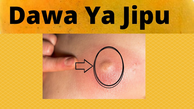 Dawa ya kukausha kidonda cha jipu
