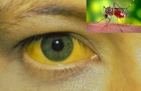 Dalili za Homa ya Manjano (Yellow Fever),Sababu na Tiba yake