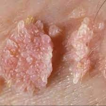 Masundosundo (Genital warts) Sehemu Za Siri