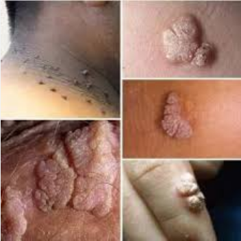 Warts Ni Nini? Aina, Sababu, Dalili, Mambo ya Hatari na Matibabu
