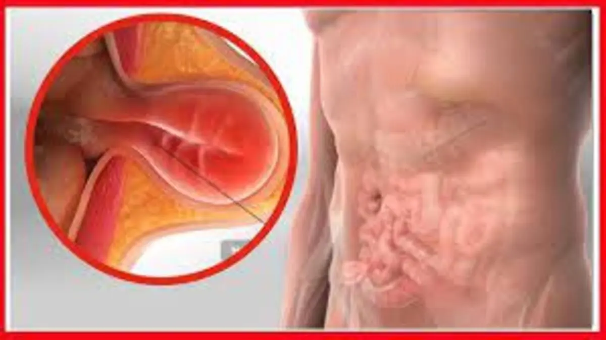 Ugonjwa wa Ngiri (hernia) kwa Mwanaume,Dalili zake,Sababu na Tiba