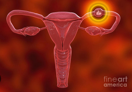Fahamu Chanzo cha Tatizo La Mimba Kutunga Nje Ya Kizazi (Ectopic Pregnancy)