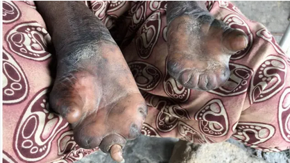Ukoma husababishwa na nini? Ukoma husababishwa na nini?