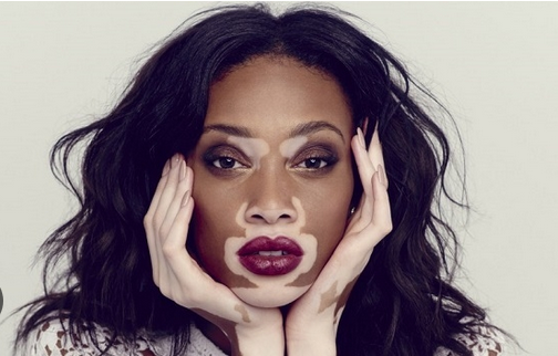 Dawa ya Ugonjwa wa Vitiligo – Tiba za Kisasa na Asili