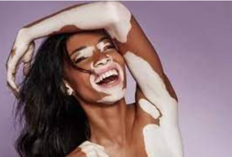 Vitiligo ni ugonjwa gani