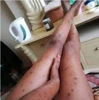 Madhara ya mchafuko wa damu