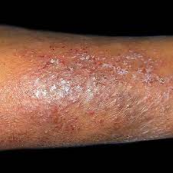 Madhara ya pumu ya ngozi Madhara ya pumu ya ngozi