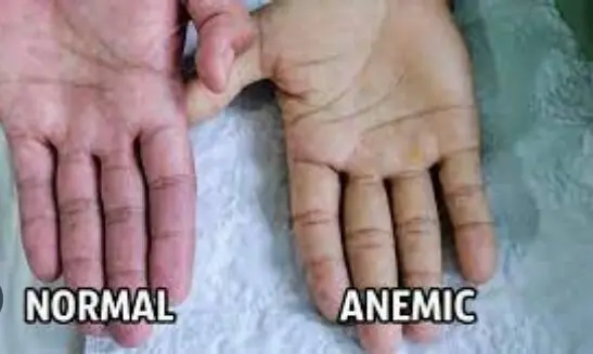 Anemia husababishwa na nini