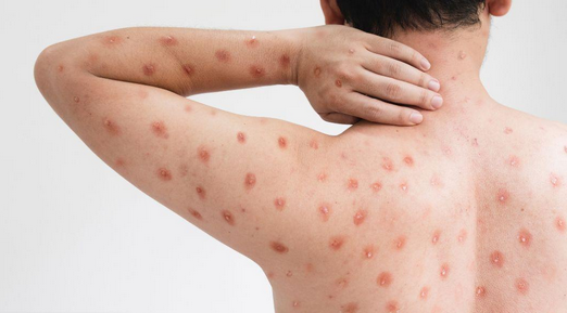 Dalili za Ugonjwa wa Ndui, Sababu na Tiba Yake Dalili za Ugonjwa wa Ndui, Sababu na Tiba Yake