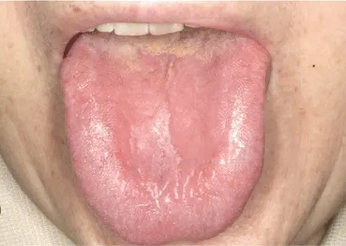 Ukosefu wa vitamini c husababisha ugonjwa gani