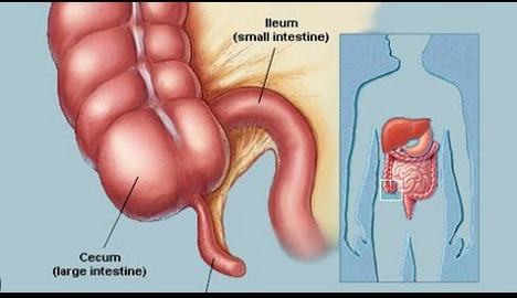 Dalili za ugonjwa wa Appendicitis, Sababu na Tiba