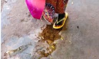 Dalili za ugonjwa wa Fistula, Sababu na Tiba