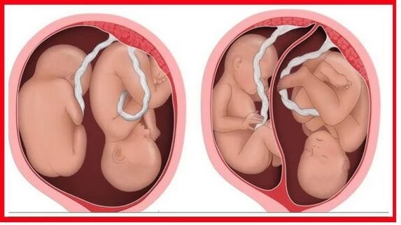 Jinsi ya kupata mapacha kwa njia ya asili